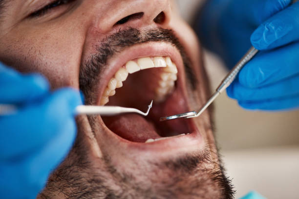 Best Emergency Dentist for Knocked-Out Tooth in Seeley, CA